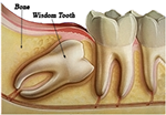 Picture showing an example of an Impacted Wisdom tooth with lablels